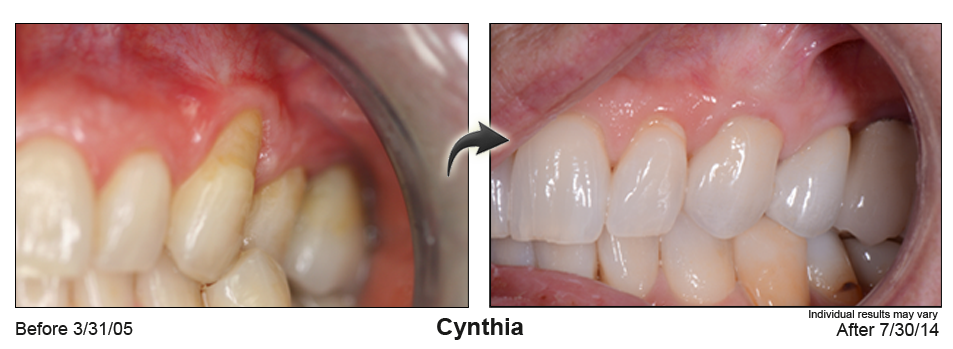 Novato gum rejuvenation