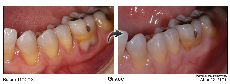 fix gum recession Mill Valley California