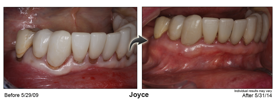 pinhole gum rejuvenation Mill Valley California