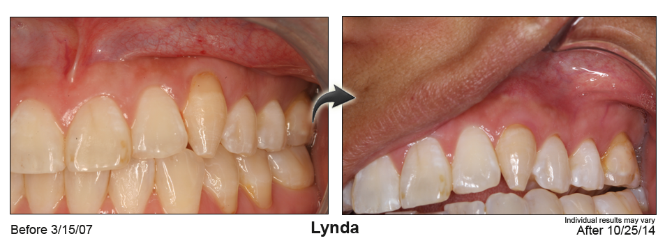 Mill Valley lunchtime gumlift dentist