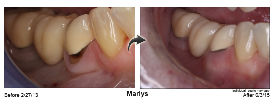 fix receding gums Mill Valley California