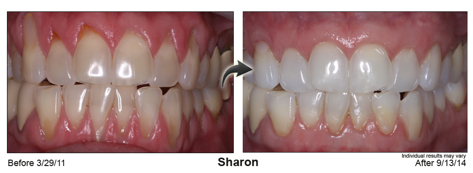 gum recession treatment Mill Valley California